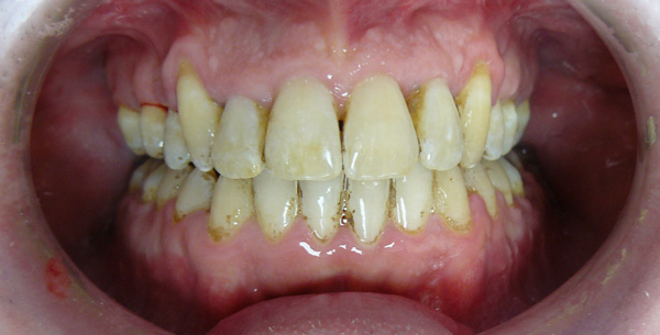 ortodonticko-chirurgická spolupráce